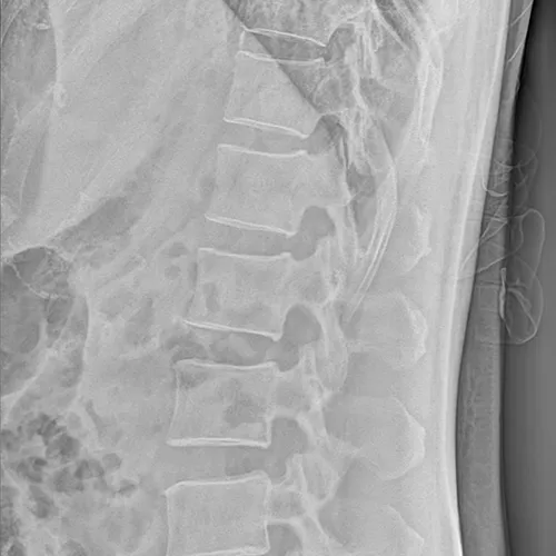 Radiografía de la Columna Vertebral