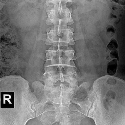 Radiografía Abdominal