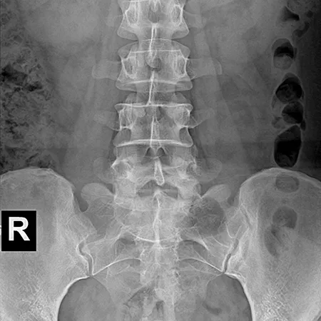 Radiografía Abdominal