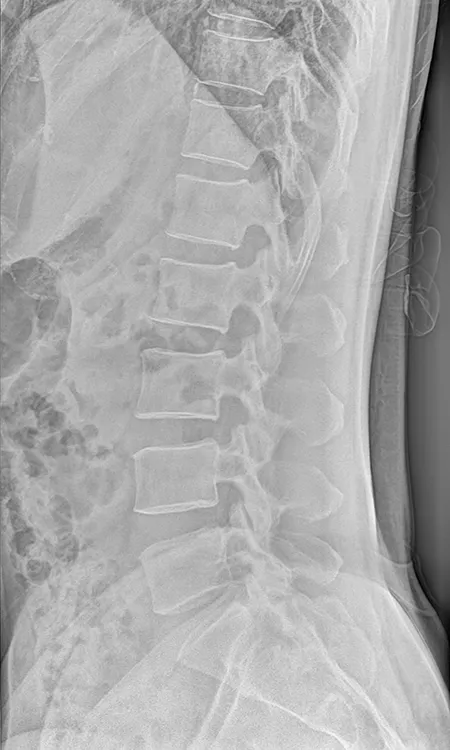  Radiografía Lumbar