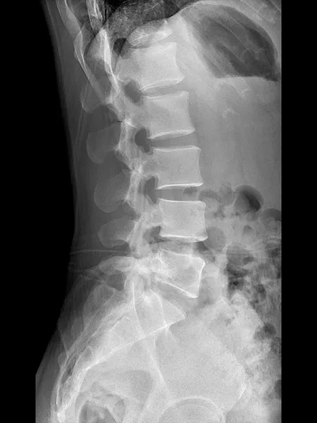 Radiografía Lateral de la Columna Vertebral
