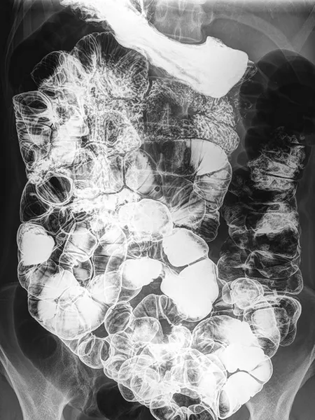 Radiografía del Intestino Delgado