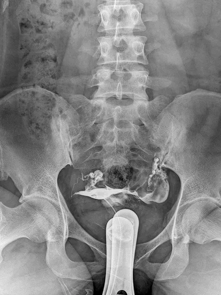 Radiografía del Aparato Reproductor