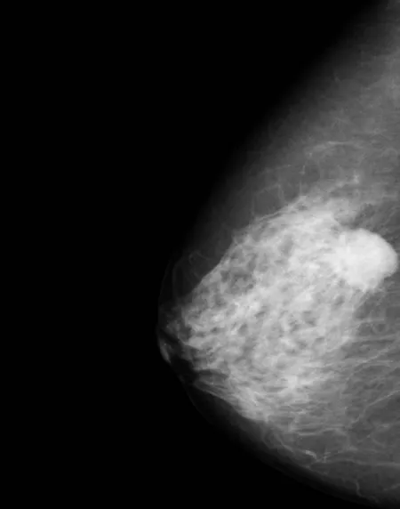 Imagen de un Tumor