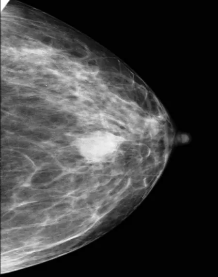 Imagen de un Tumor